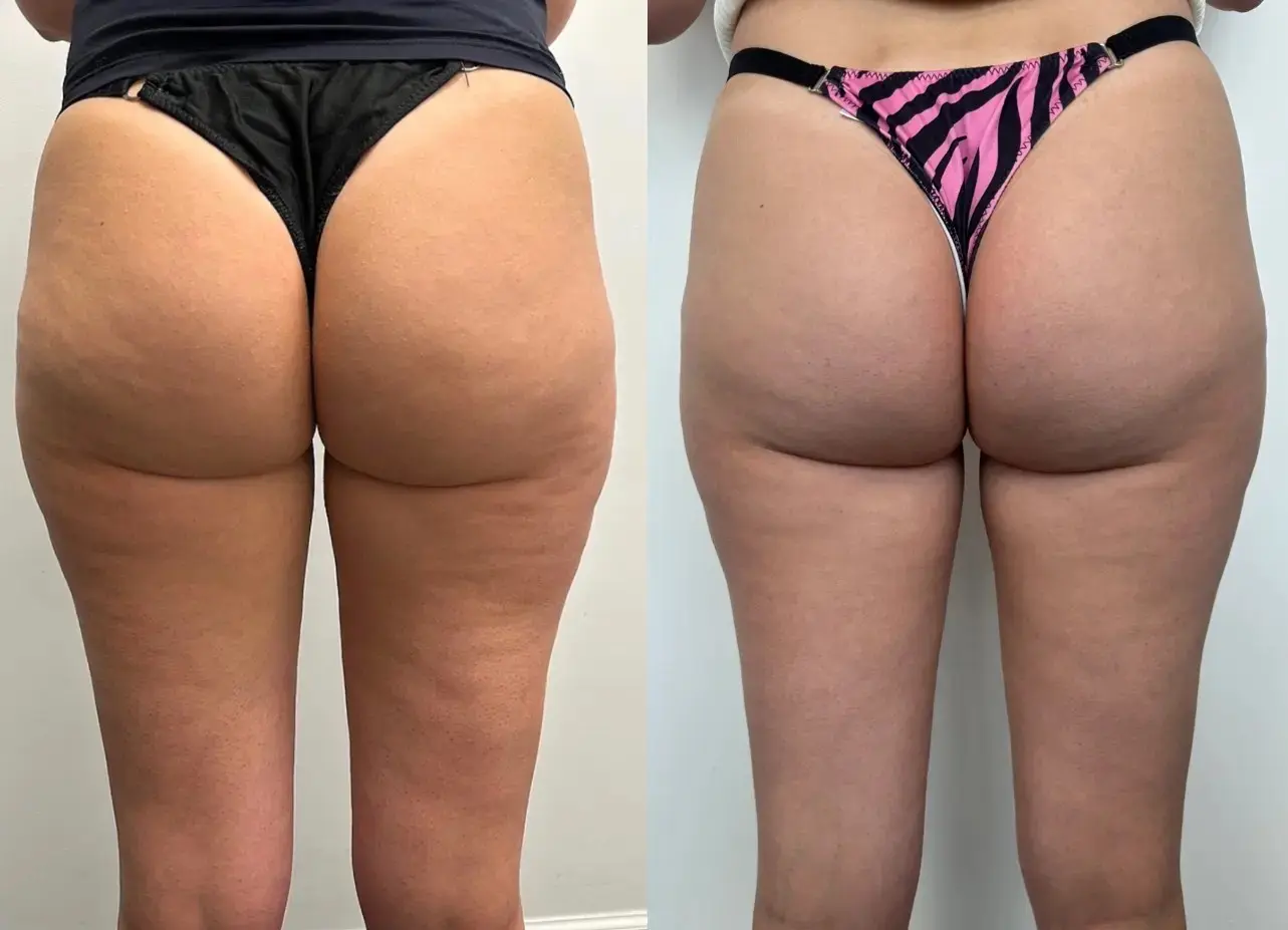 Radiofrecuencia en piernas - Bioestimulación